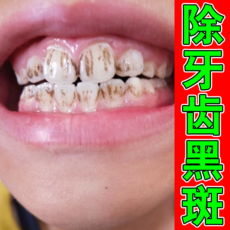牙齿黑斑黄渍色素沉淀牙齿污垢