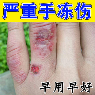 冻疮膏手指冻伤膏冬天手足耳朵冻伤红肿防冻裂冶冻疮修复膏