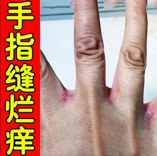 手指缝溃烂软膏经常湿水洗碗手缝发白气脱皮干燥烂手丫糜烂专用膏