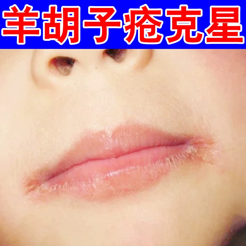 小孩舔嘴唇嘴周围红肿儿童羊胡子疮唇炎膏专用上火起泡烂嘴角开裂