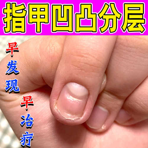 受损指甲凹陷变形坑洼手指甲凹凸不平萎缩修液手指复脚趾甲营养油