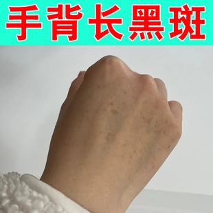 手背上的老年斑手背黑斑黄褐斑日晒黑点太阳斑手部黑色素沉淀软膏