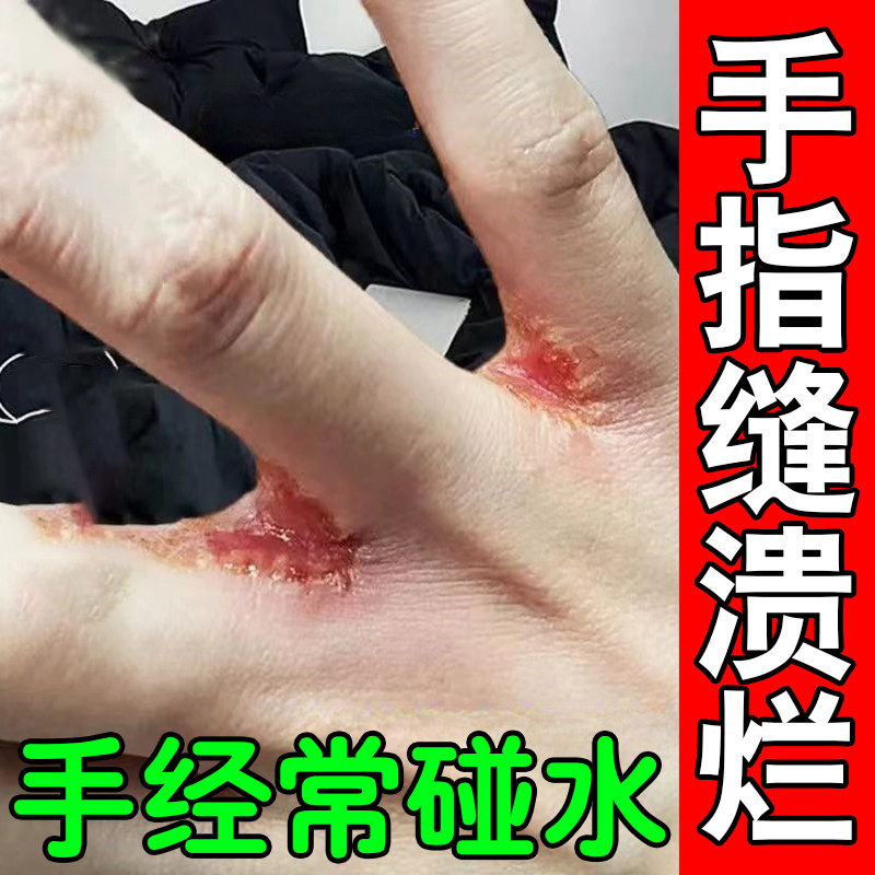 手指缝溃烂痒经常碰水脱皮长水泡发红干裂口手鲜烂手丫专药用软膏
