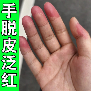 手干燥开裂手指头干裂疼痛粗糙龟裂起皮手心裂口子手皴脱皮