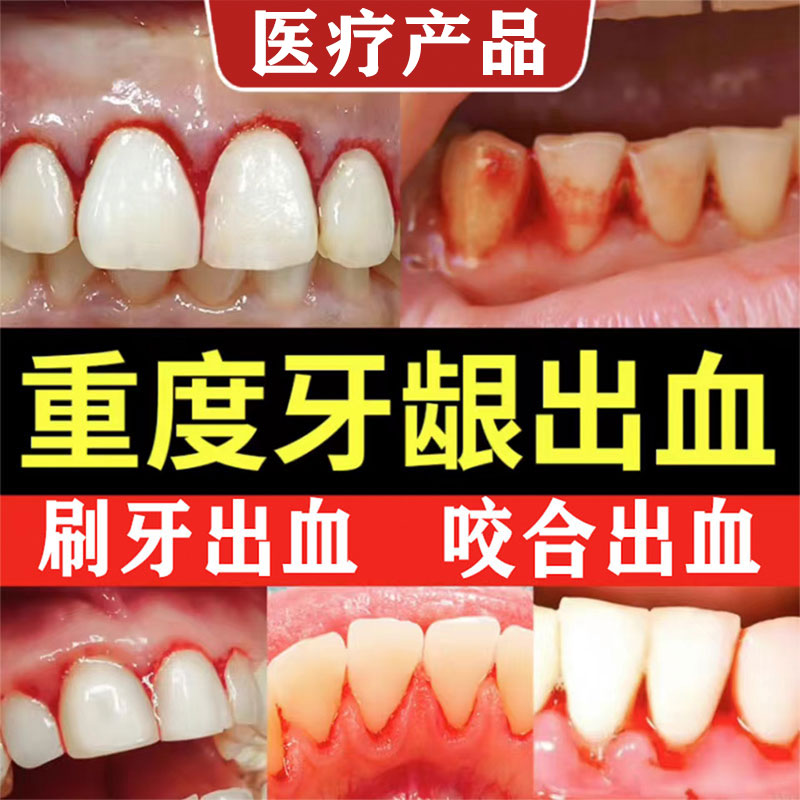 云南牙膏白牙周炎牙龈专出血用双效抗敏官方旗舰店正品药监备案GX