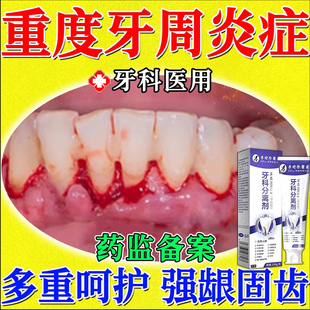 牙膏牙周炎牙龈出血专用口腔消炎止痛固齿抗敏萎缩松动牙根暴露TT