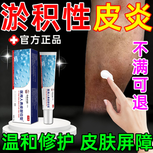 淤积性皮炎小腿发黑发紫瘙痒红肿静脉曲张静脉炎湿疹专用修复膏WY