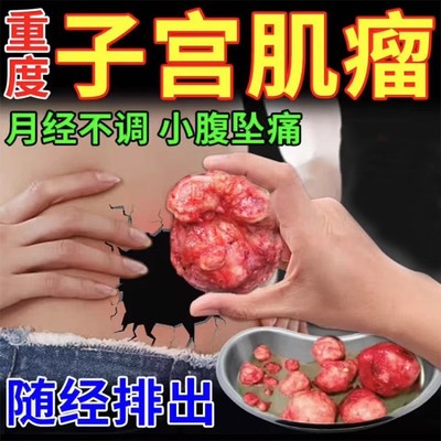 子宫肌瘤中药贴特效药泡脚包巧克力卵巢囊肿多发性腺肌症吃什么TT
