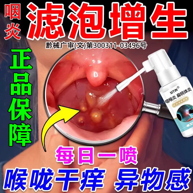 治疗喉咙滤泡增生后壁淋巴慢性咽炎咽喉炎根专慢性咽炎除用喷剂LL