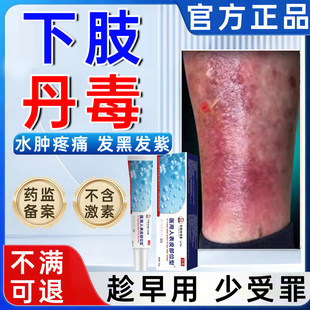 丹毒专用软膏小腿红斑疼痛下肢水肿灼热发黑发紫皮肤受损修复膏WY