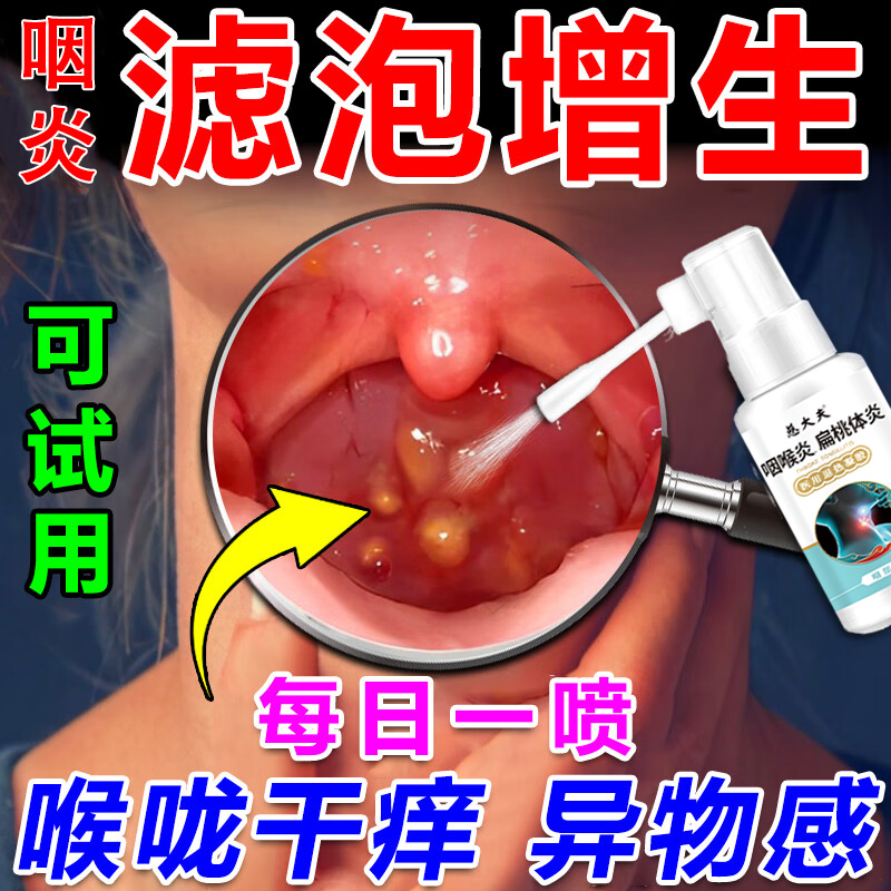 治疗喉咙滤泡增生后壁淋巴慢性咽炎咽喉炎慢性咽炎除根专用喷剂LL