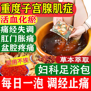 子宫腺肌症的药内膜异位宫寒痛经纤维肌瘤中药贴泡脚包调理盆腔GX