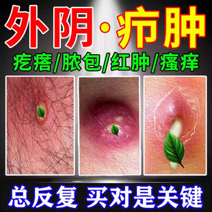外阴疖肿拔毒膏火疖子药膏拔脓膏脓包硬块敷贴屁股上私处长痘痘LL