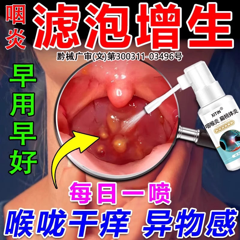治疗喉咙滤泡增生后壁淋巴慢性咽炎咽喉炎根专慢性咽炎除用喷剂LL