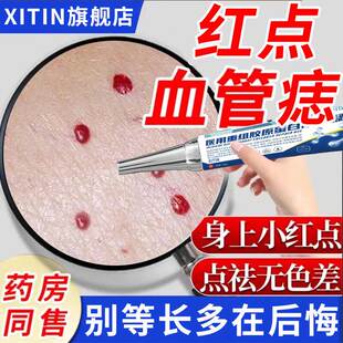 祛除红点血管痣樱桃状血管瘤蜘蛛痣疣点痣祛血痣黑疙瘩无痕凝胶ZT