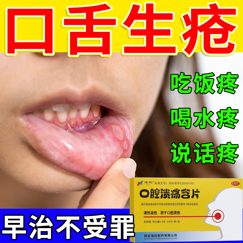 口腔溃疡特新效药治口舌生疮石辛舌头烂吃什么药溃烂疼痛专用含片