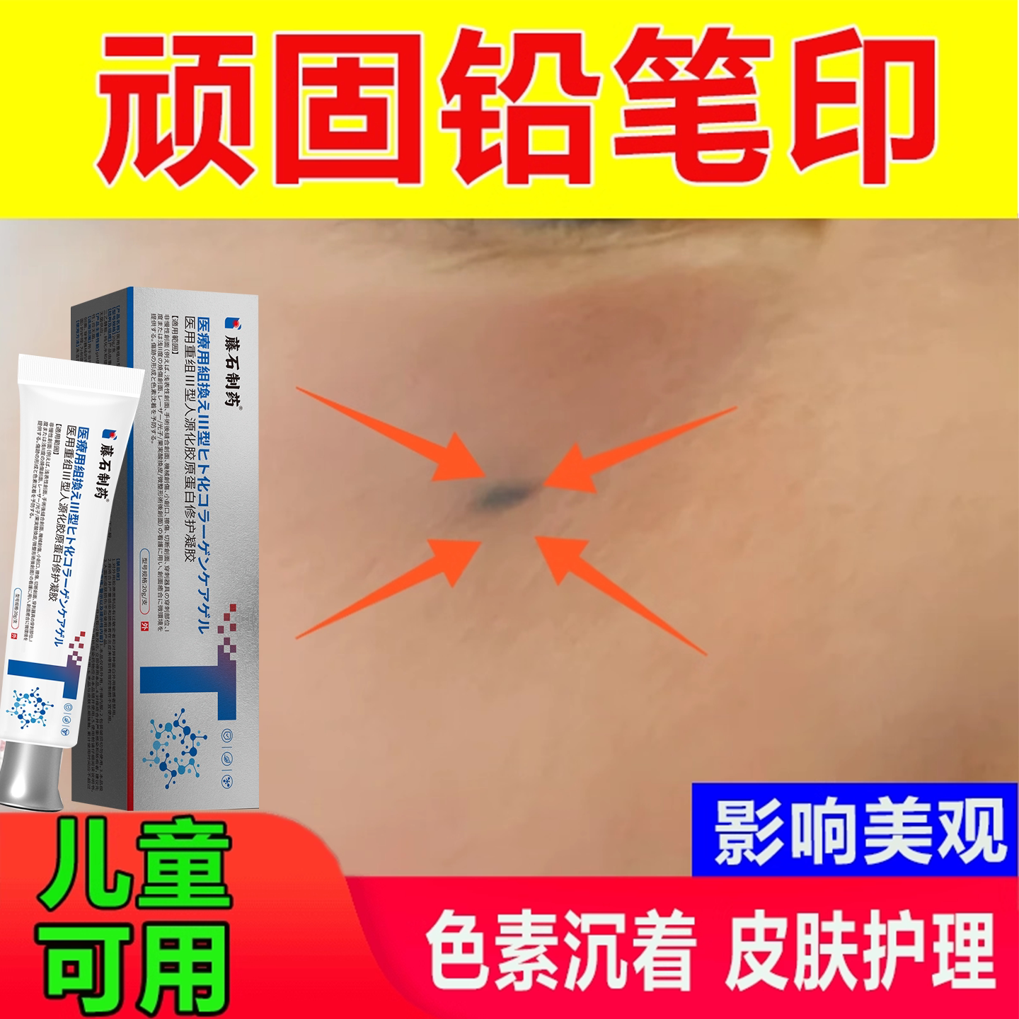 铅笔黑印子去除祛痣点无痕正品去脸上斑点黑色素瘤沉淀药监备案wg