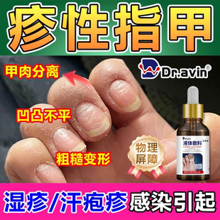 湿疹指甲凹凸修不平汗疱疹复空指甲床脱液灰指甲银屑病增厚真菌wg