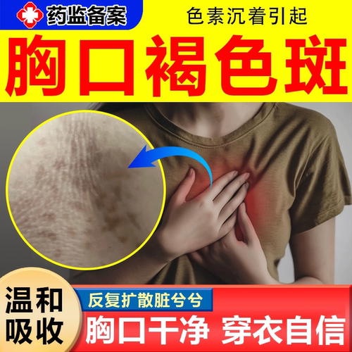 胸部汗斑花斑癣乳沟褐色黑斑喷剂