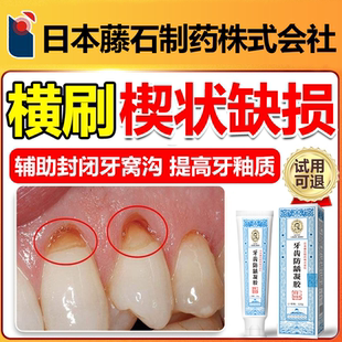 牙齿楔状缺损修补牙膏牙周炎口腔牙龈缩敏感酸痛修护龈复医用wg