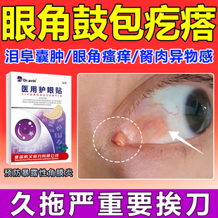 眼睛眼角里面瘙痒长胬肉泪阜囊肿霰粒角膜炎非眼药水叶黄素眼贴wg
