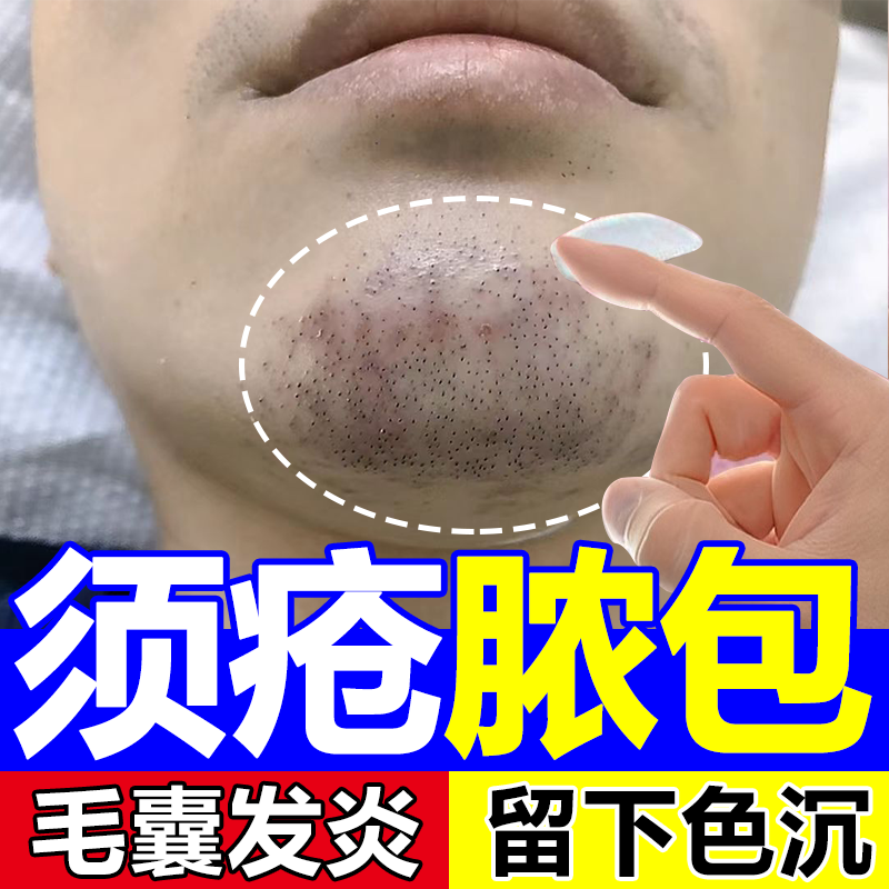 下巴胡子长痘痘脓包丘疹疙瘩马拉色菌脂溢性痤须疮毛囊炎搭药膏wg