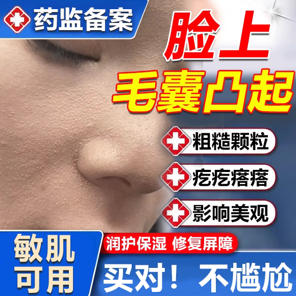 脸颊毛囊角化儿童鸡皮肤颗粒疙瘩去除改善面霜角质身体乳手臂wg