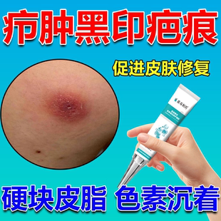 火疖子结痂愈合留黑印硬块疖肿疙瘩脓包去除皮肤疤痕黑色素沉淀wg