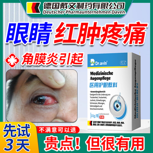 真菌性病毒性角膜炎结膜炎生长因子修复进口熊胆搭滴眼液眼药水xj