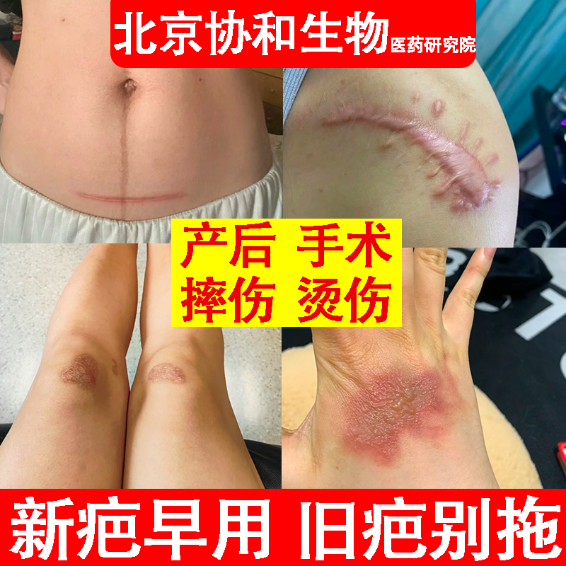 医用疤痕修复剖腹产硅祛疤膏摔伤凸起烧伤酮黑色素除疤凝胶正品wg 医疗器械 祛疤产品 原图主图