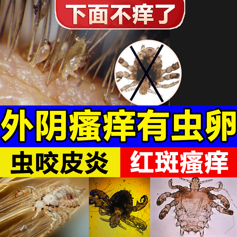 私处长阴虱子瘙痒男女用止痒外阴毛百步部灭虱子酊一扫光旗舰店wg