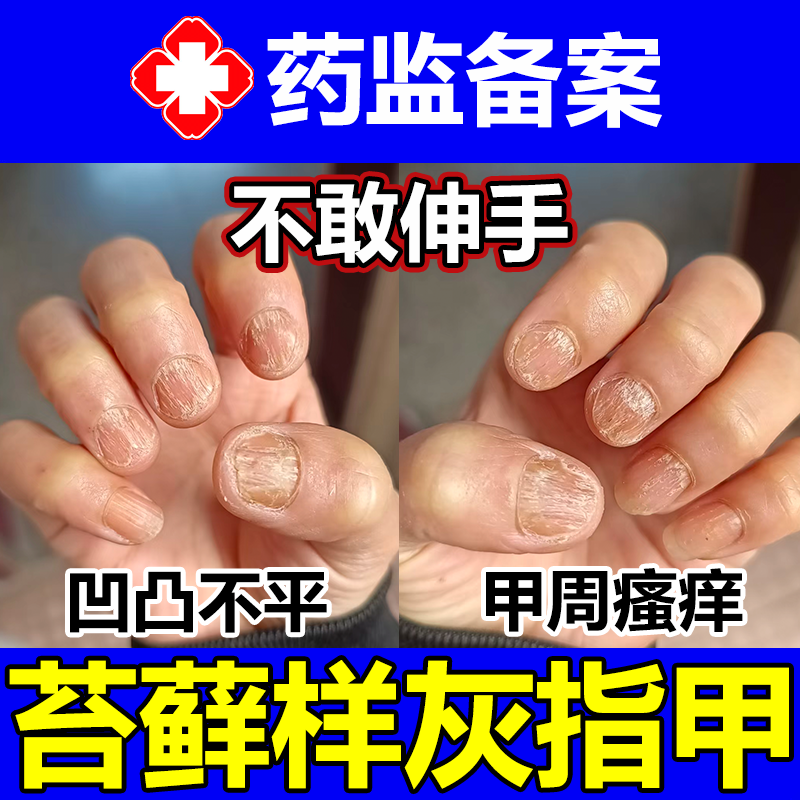 指甲扁平苔藓癣凹凸不平粗糙灰指甲周瘙痒营养不良真菌感染脱甲wg