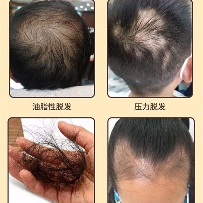 头发生髪贴快速增发剂防脱发短发变长M变多自然生长快养发贴