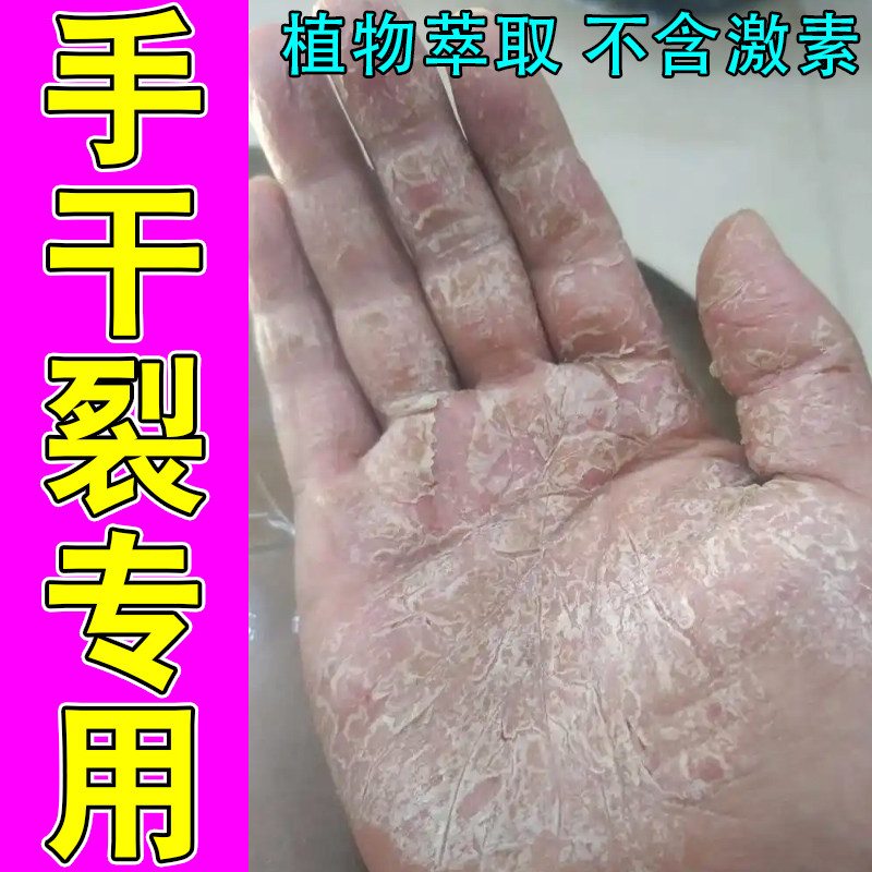 手干裂专用手痒手蜕皮掉屑红肿角化型皮肤粗糙增厚手掌心脱皮干燥
