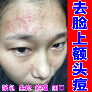 脸上额头痘痘儿童脸上起小疙瘩黑头坐疮红肿硬块脂肪粒粉刺闭口