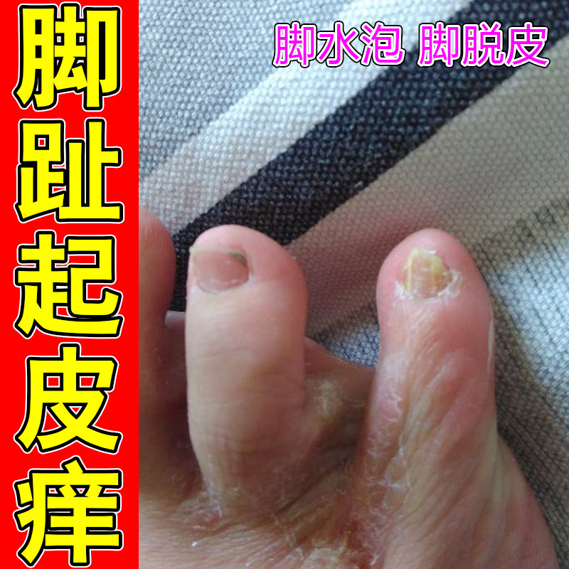 脚趾起皮痒脚趾缝裂口泛白臭干燥脱皮痒烂真菌脚臭汗脚专用修复药