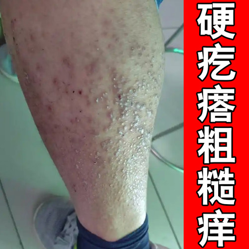 硬疙瘩粗糙痒胳膊小腿背后顽固褐色蛋白沉积黑色素沉淀刺挠痒修护