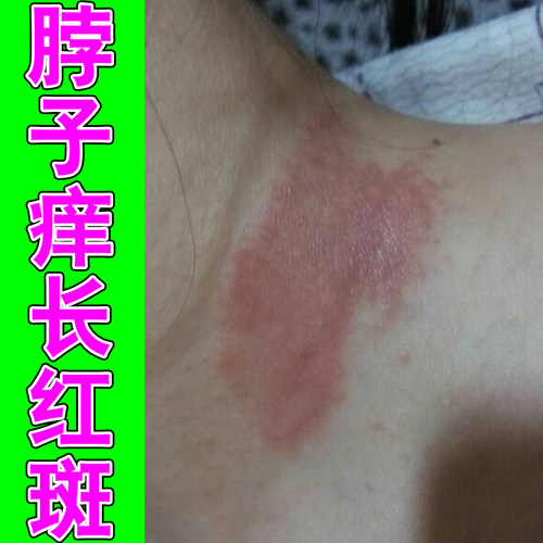脖子痒长红斑起疙瘩痒痘神经性皮肤干燥蜕皮一挠一片红肿出汗痒痛