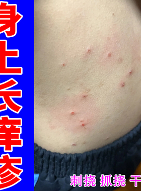 结节硬疙瘩小腿红肿痒疹丘疹身上长红斑小腿皮肤干燥粗糙痒外用药