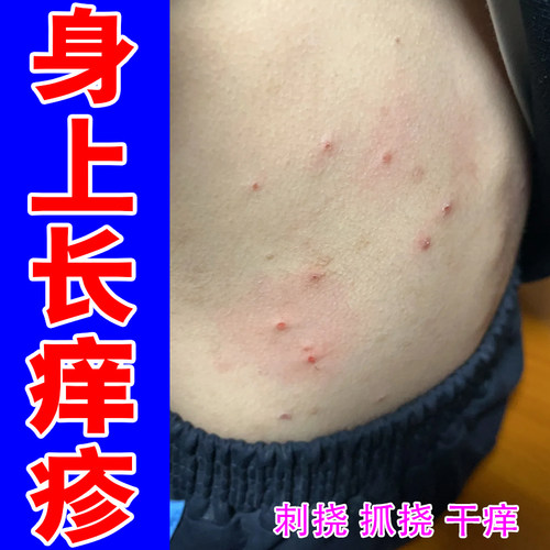 结节硬疙瘩身上皮肤干燥红点药乳