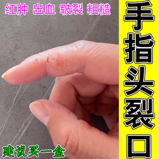 手指头裂口指甲缝开裂手脱皮蜕皮秋冬防裂手指关节修复药