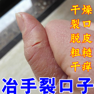 手指头裂口子干裂修复护手霜开裂脱皮裂开手足开口手脚冬季裂膏