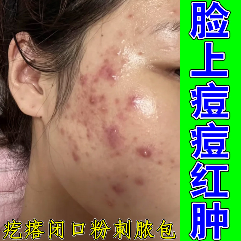 脸上痘痘红肿干燥粗糙换季过敏内分泌失调脸颊两侧脓包痘疙瘩颗粒