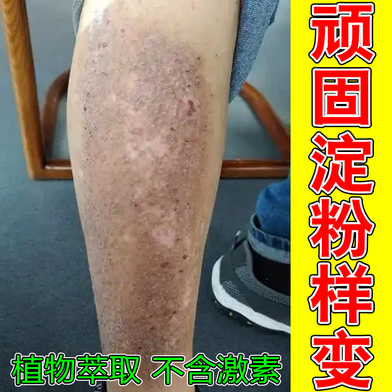 腿上粗糙颗粒凸起疙瘩小腿痒褐色沉淀四肢发痒剧烈干燥粗糙红疹子