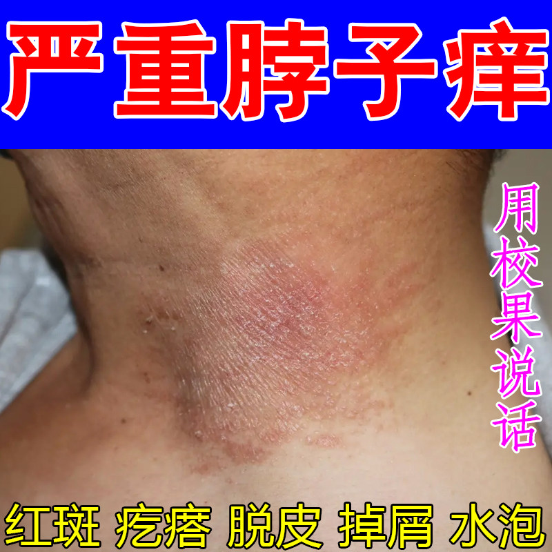 严重脖子痒紫外线过敏神经起红疙瘩红点痘痘出汗红肿痒刺挠抓挠痒