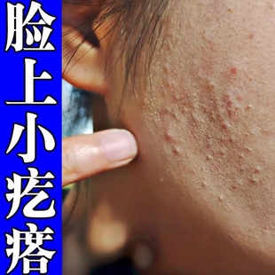 祛痘痘印痘坑修复膏快速去脸上闭口额头下巴痘印痘疤红肿外用药膏