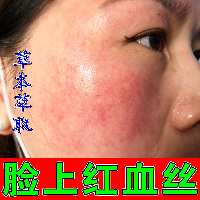 冶脸上有红血丝明显皮肤干燥粗糙皮肤消毒护理（消）