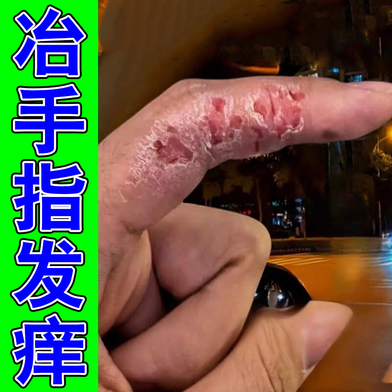 手指关节痒手指脱皮干裂起小水泡手痒手指皮肤变硬干燥起皮外用膏
