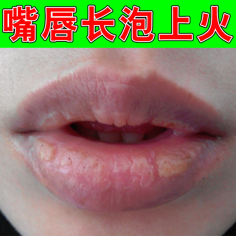 嘴角干裂上火疼痛草本修护软膏嘴皮肤消毒护理（消）