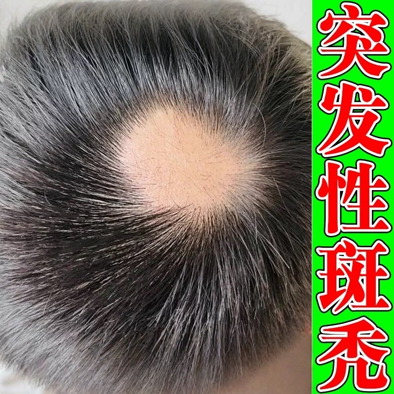 斑秃特效生发液鬼剃头后脑勺小块秃掉发突发性斑秃防脱发掉发神器
